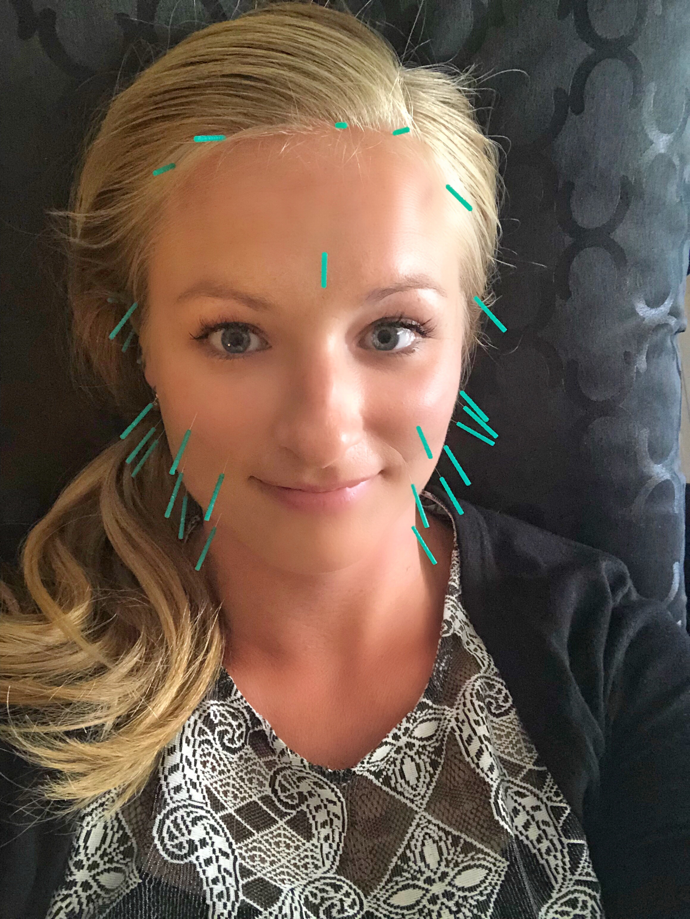 I Tried Cosmetic Acupuncture to See What This Natural Anti-Aging Procedure Was All About